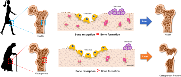 عدم تعادل در تمایز سلول های بنیادی مزانشیمی به استئوبلاست‌ها و سلول‌های چربی منجر به پوکی استخوان می شود