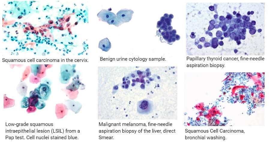 کاربرد رنگ آمیزی پاپ اسمیر در تشخیص و مطالعه انواع تومورها