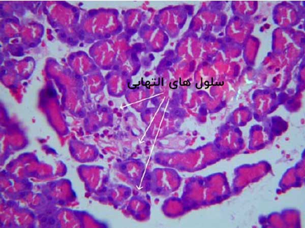 تجمع سلول های التهابی در بافت پانکراس